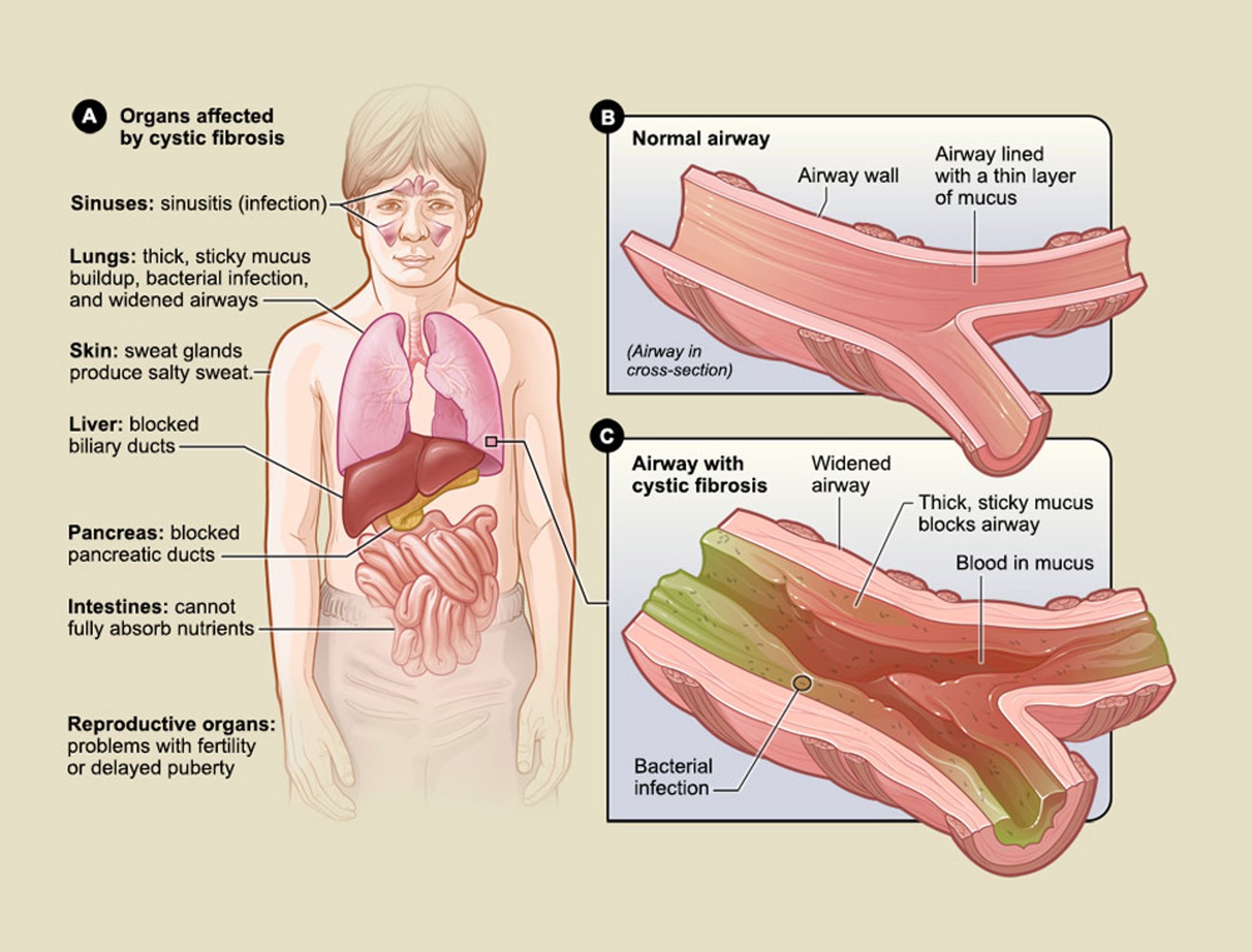 How Cystic Fibrosis Affects the Body