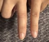 Dactilitis