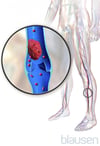 Deep Vein Thrombosis
