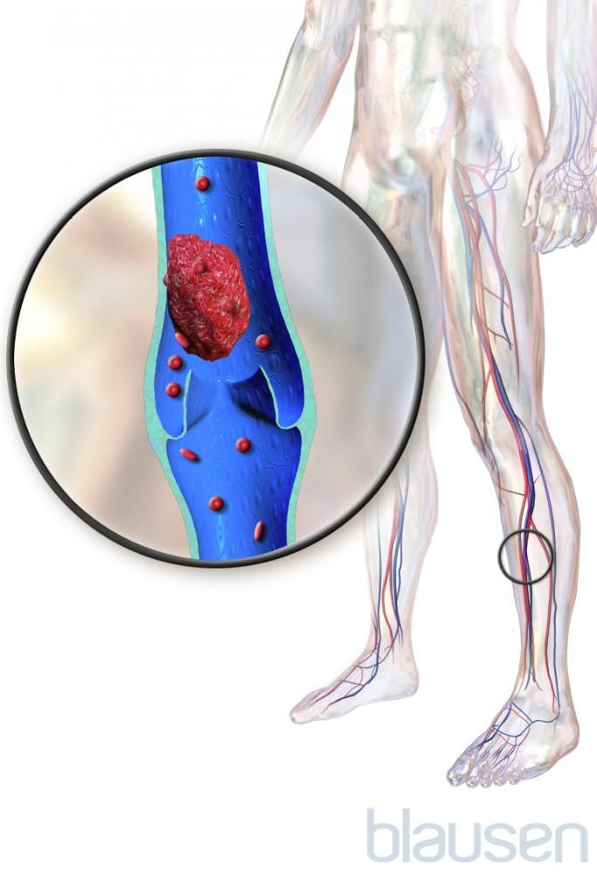Thrombose veineuse profonde