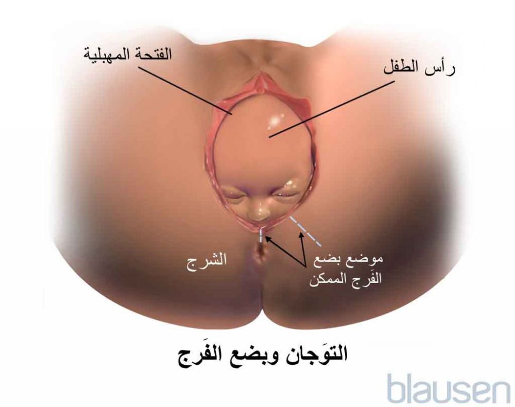 التكليل في أثناء الولادة