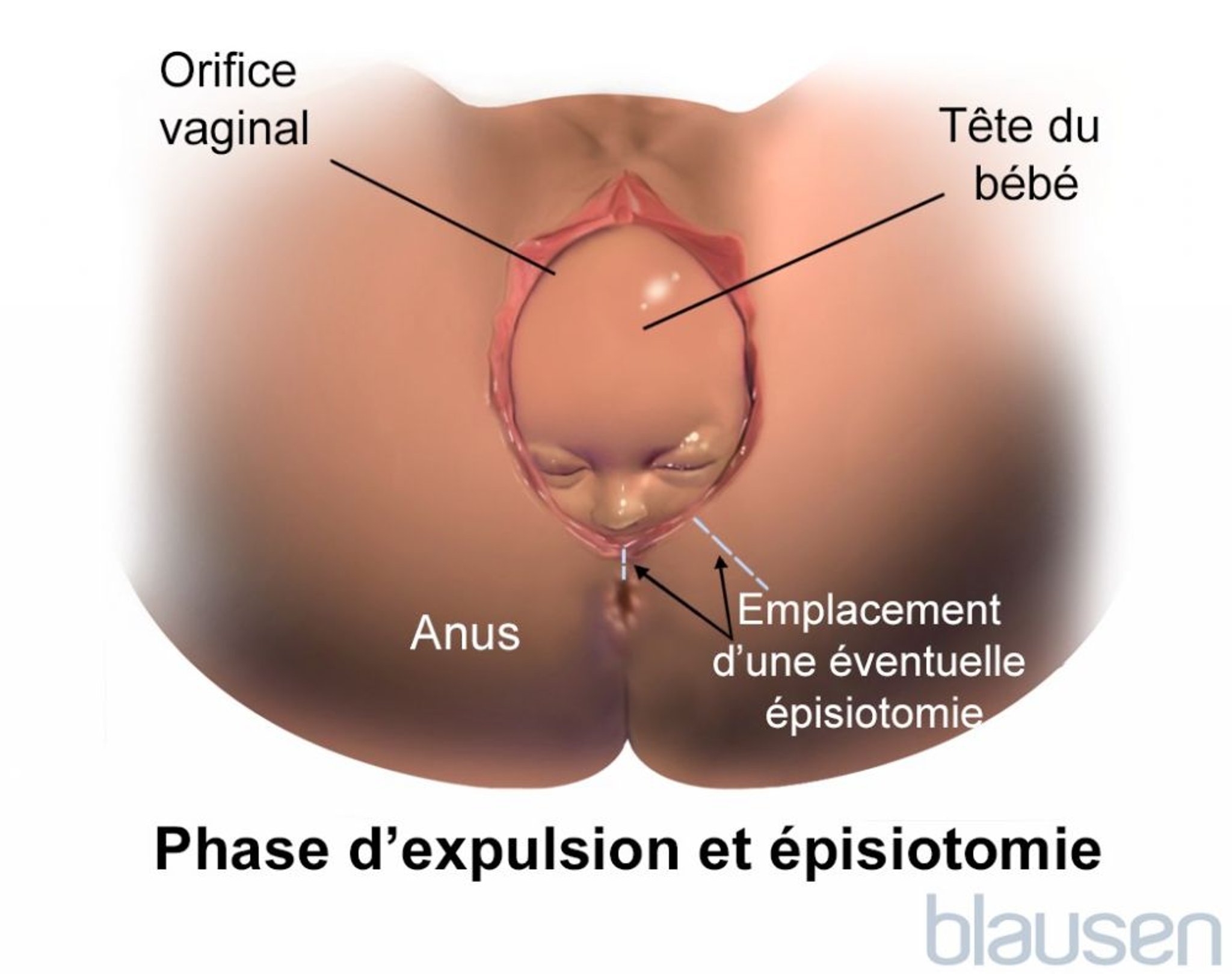 Couronnement pendant l’accouchement