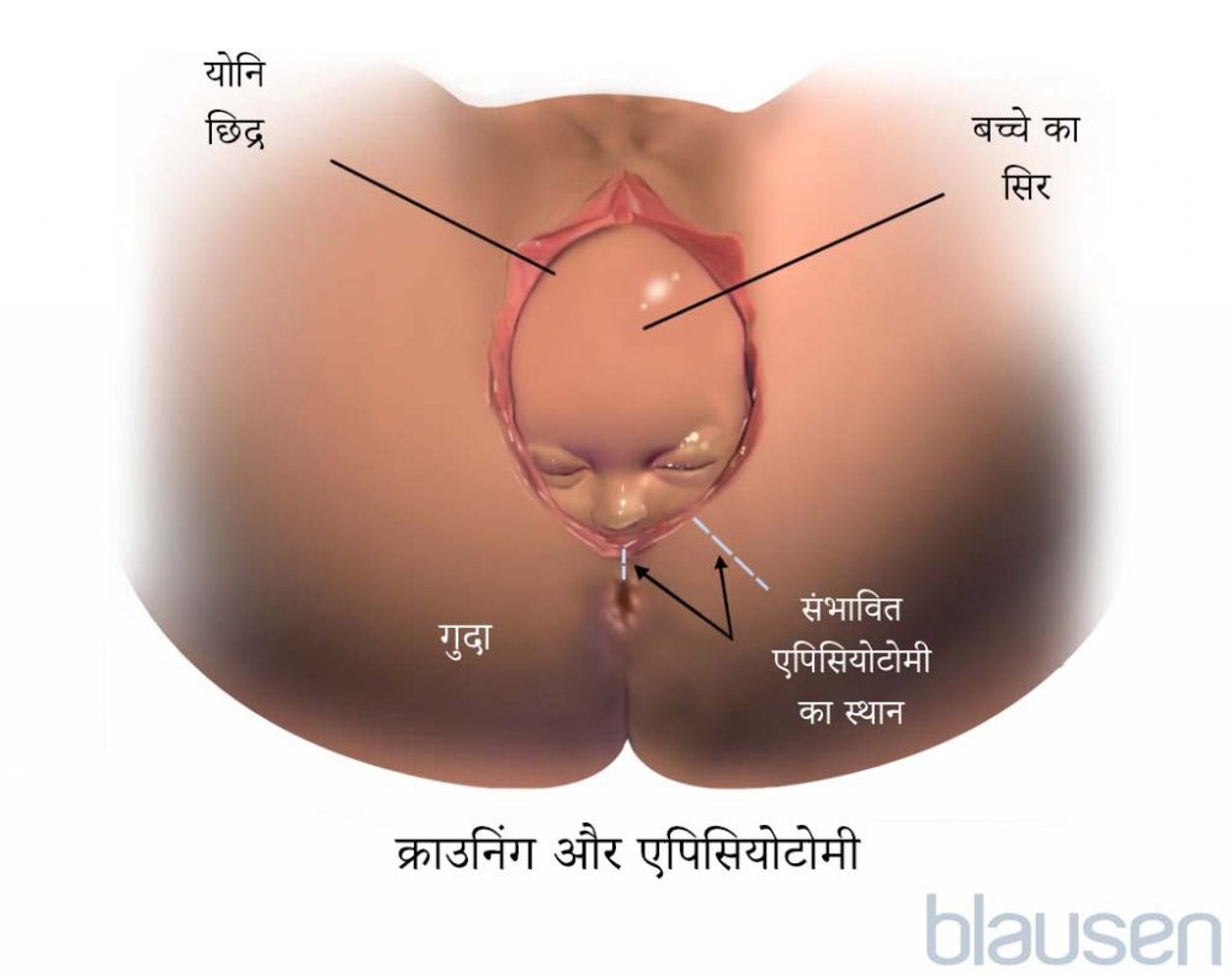 प्रसव के दौरान क्राऊनिंग
