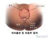 출산 중의 배림