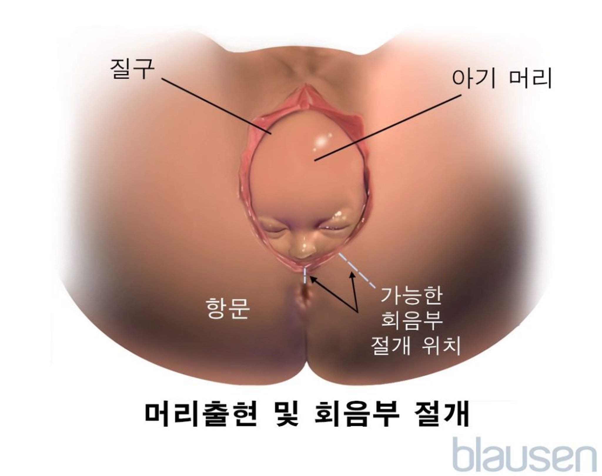 출산 중의 배림