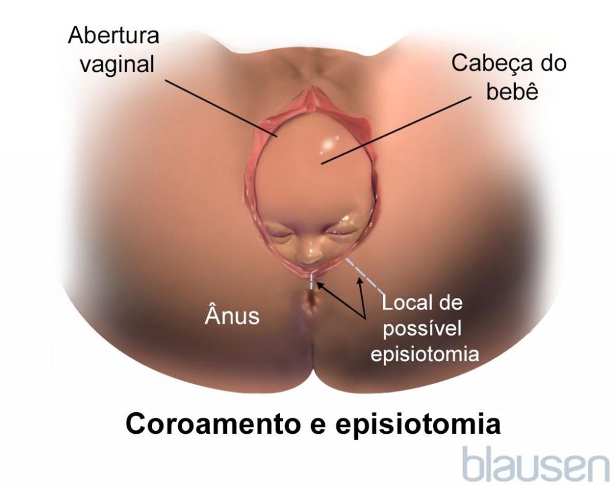 Coroamento durante o nascimento