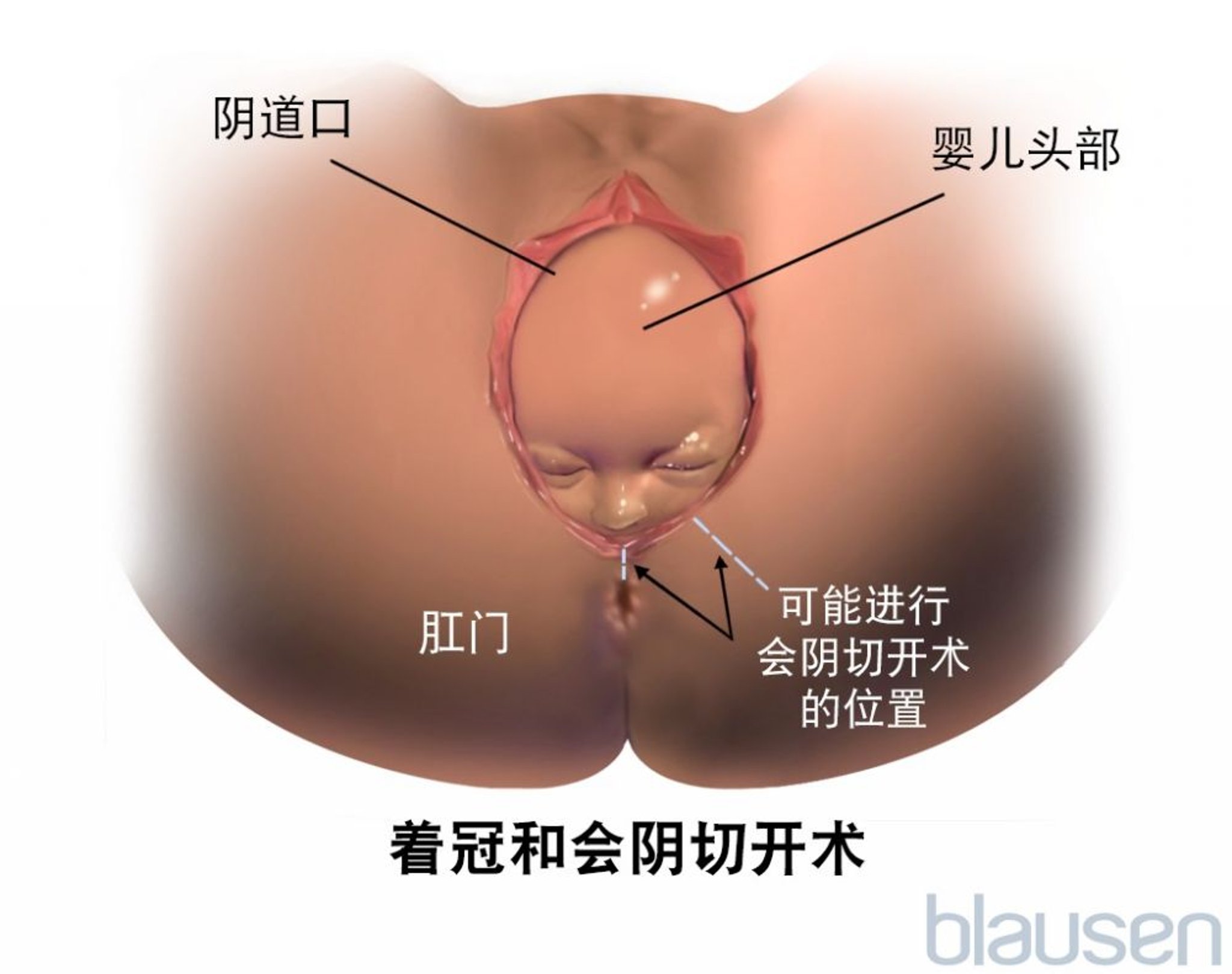 分娩期间的胎头着冠