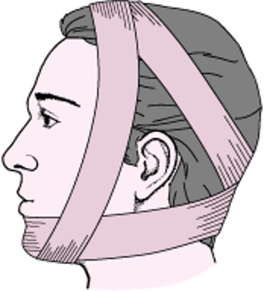 ضمادة بارتون