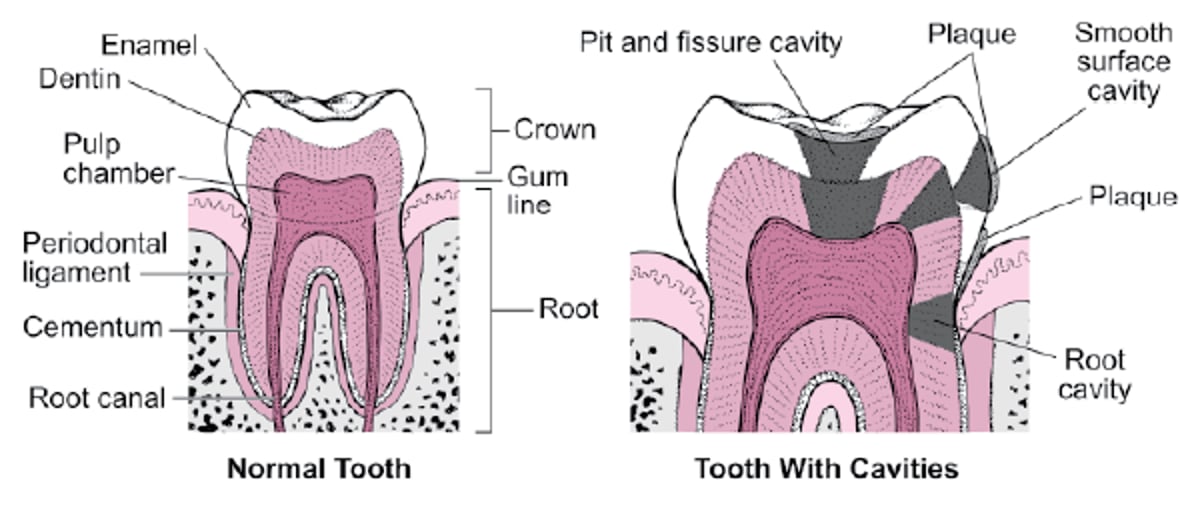 Clases de caries