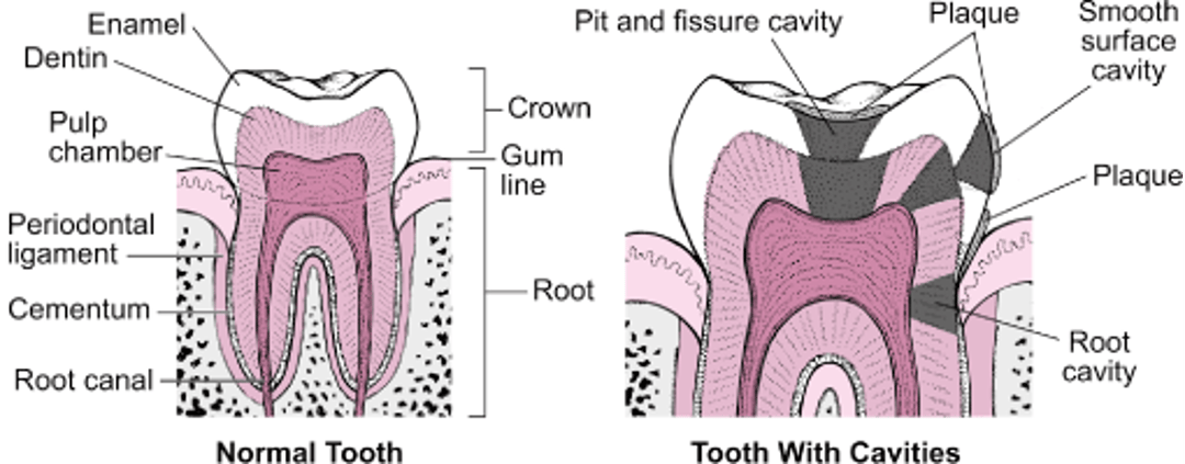 Les différents types de caries