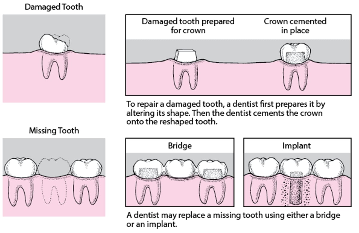 Crowns, Bridges, and Implants
