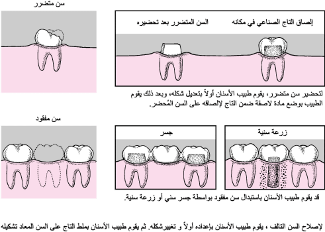 التيجان، والجسور، والزرعات السنية