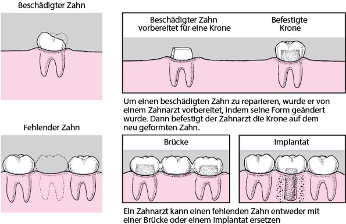 Kronen, Brücken und Implantate