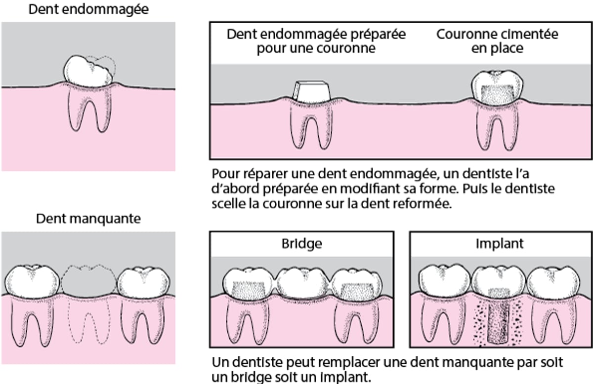 Couronnes, ponts et implants