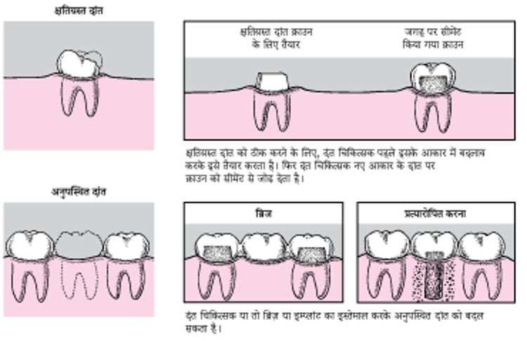 क्राउन, ब्रिज और इम्प्लांट
