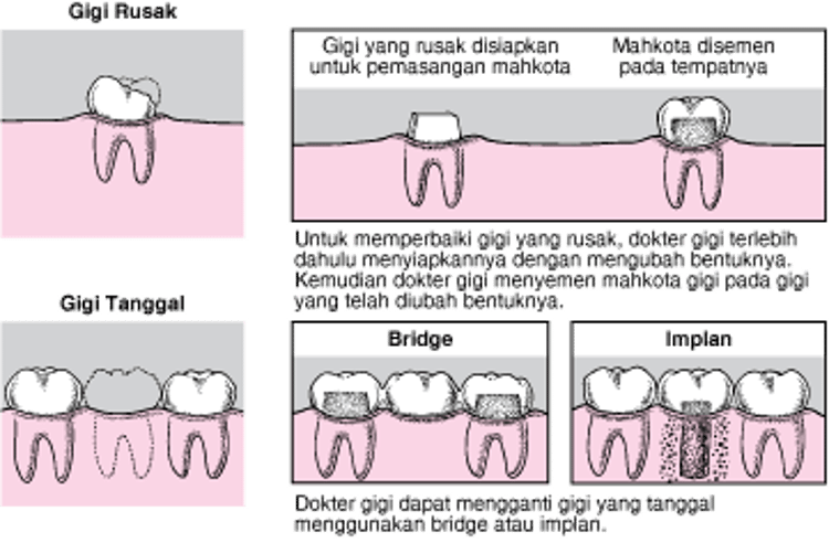 Mahkota, Jembatan, dan Implan