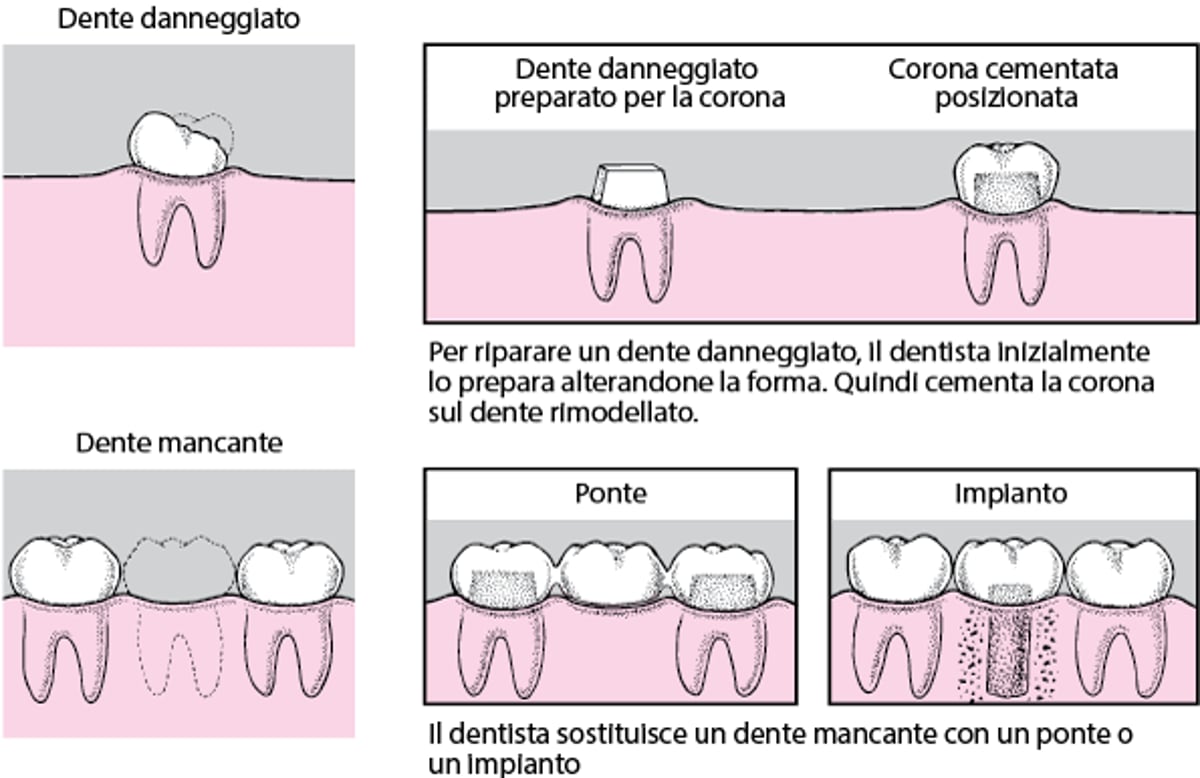 Corone, ponti e impianti