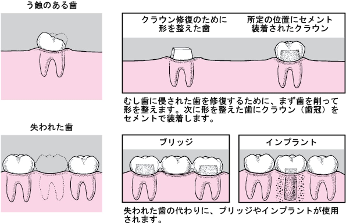 クラウン、ブリッジ、インプラント