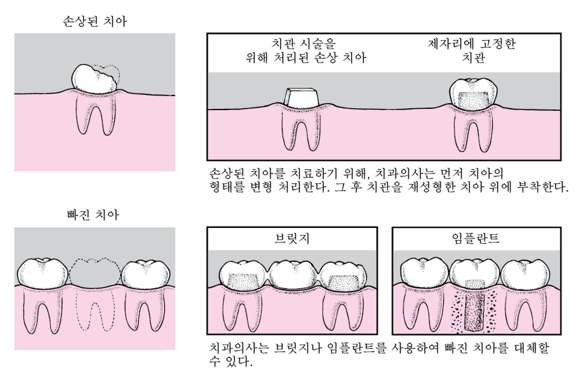 치관, 가공 의치, 그리고 임플란트