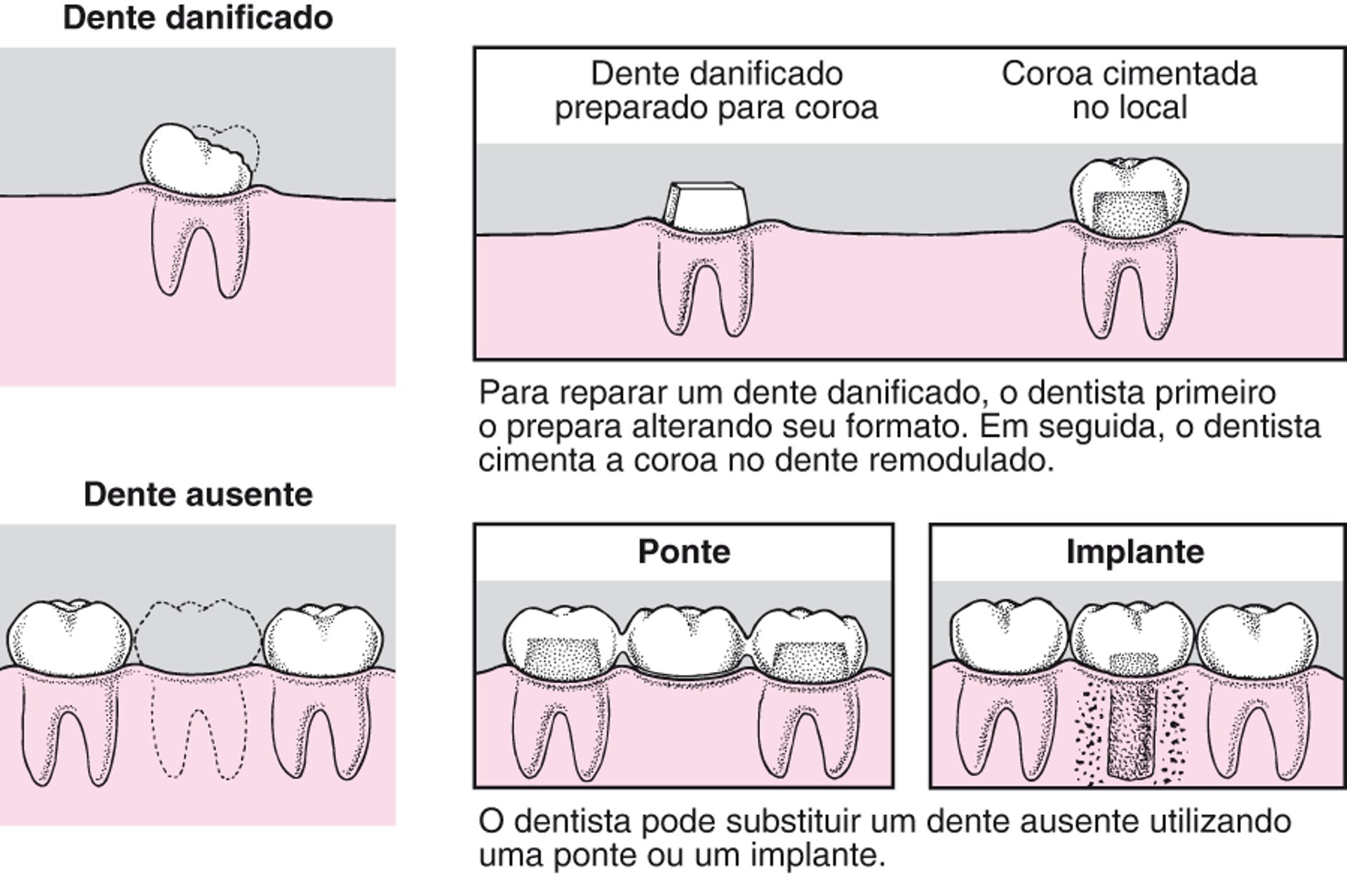 Coroas, pontes e implantes