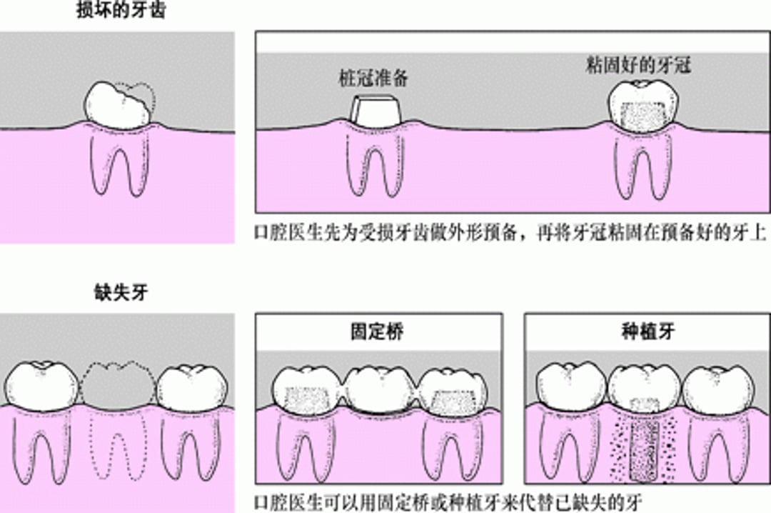 冠、桥和种植体