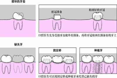冠、桥和种植体