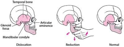 Putting a Dislocated Jaw Back in Place