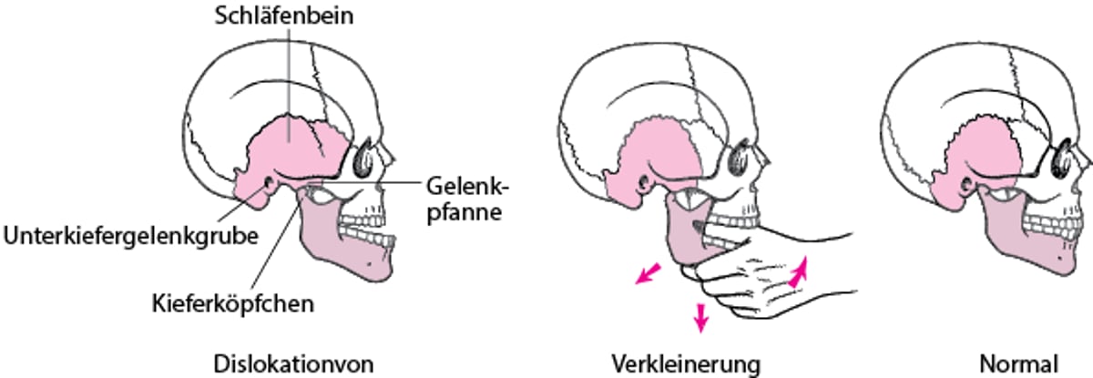 Wiedereinrenken eines Kiefers