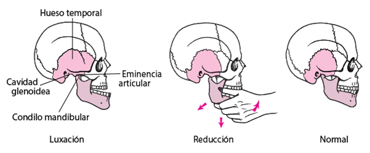Colocación de la mandíbula en su sitio después de una luxación