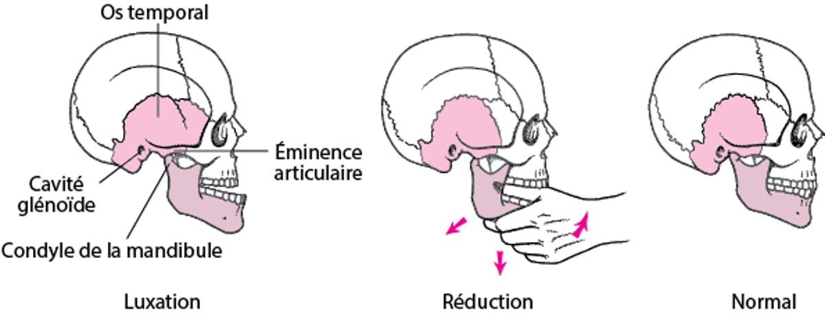 Repositionnement d’une luxation mandibulaire