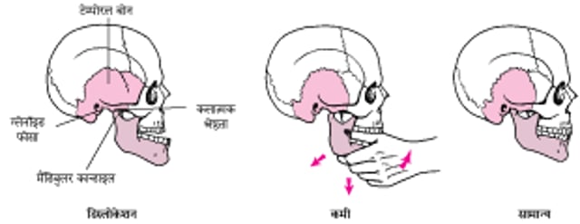 अपनी जगह से खिसके जबड़े को वापस जगह पर रखना