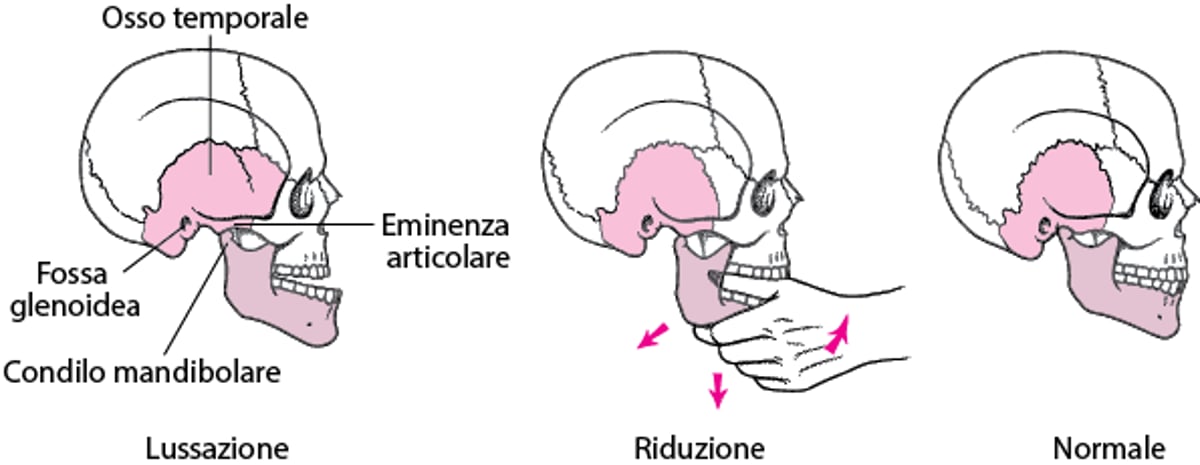 Come riposizionare la mascella dislocata