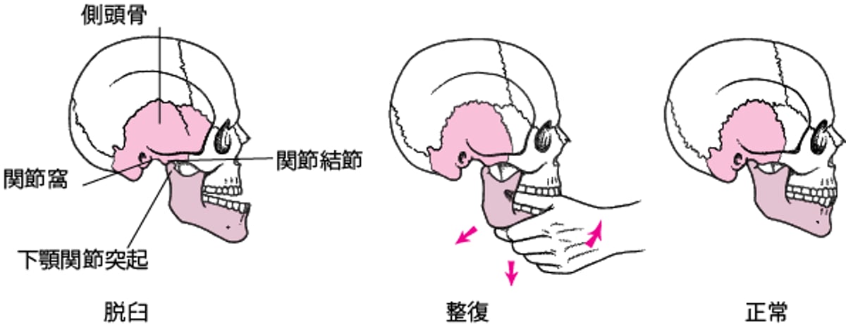 脱臼したあごを戻す