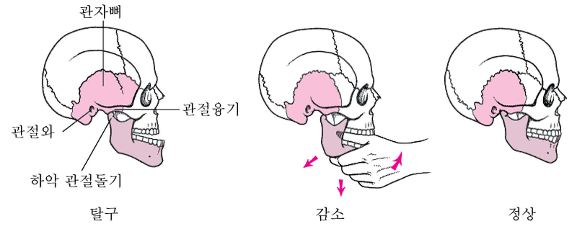 탈구 턱을 원위치로 돌려 놓습니다.