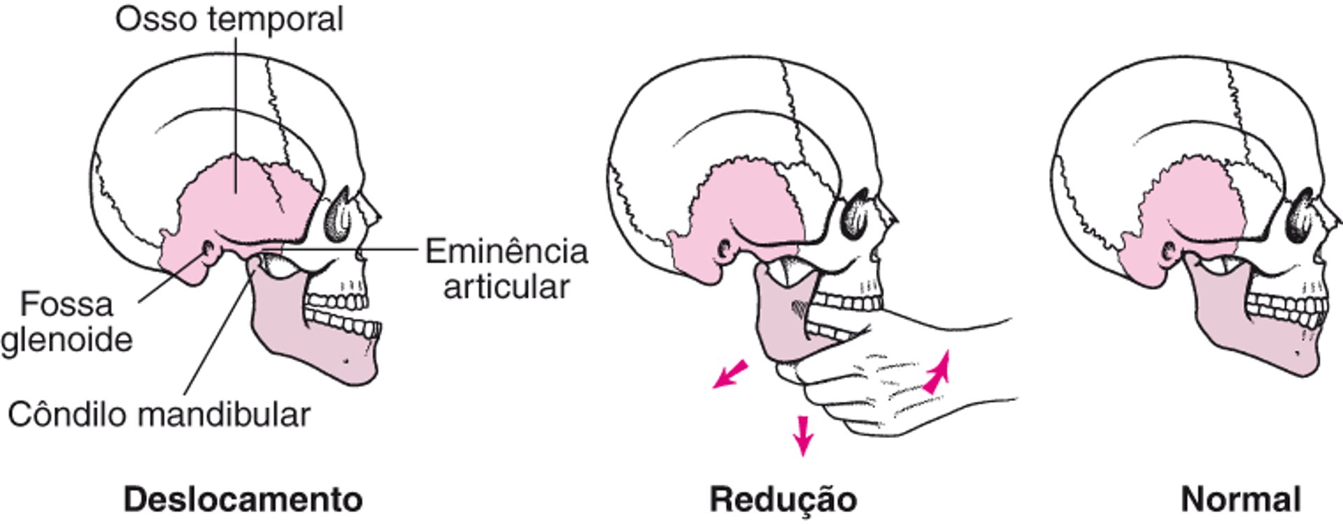 Colocando uma mandíbula deslocada de volta ao seu lugar