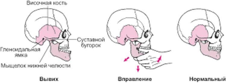 Вправление смещенной челюсти