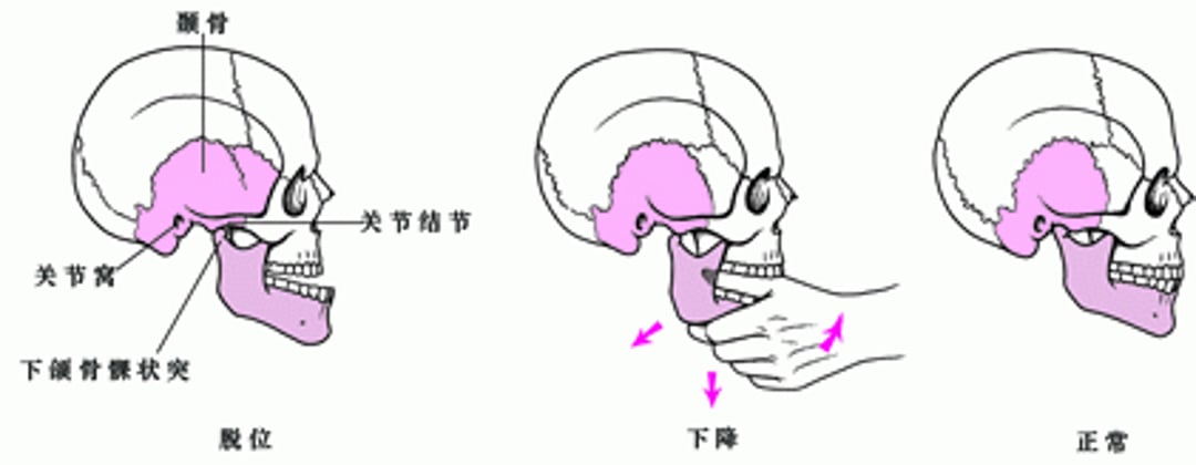 把脱臼下巴恢复原位