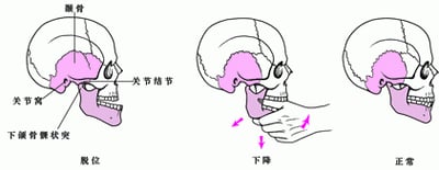 把脱臼下巴恢复原位