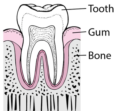 Periodontitis: From Plaque to Tooth Loss