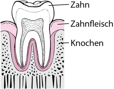 Parodontitis: Von Zahnbelägen zum Zahnverlust