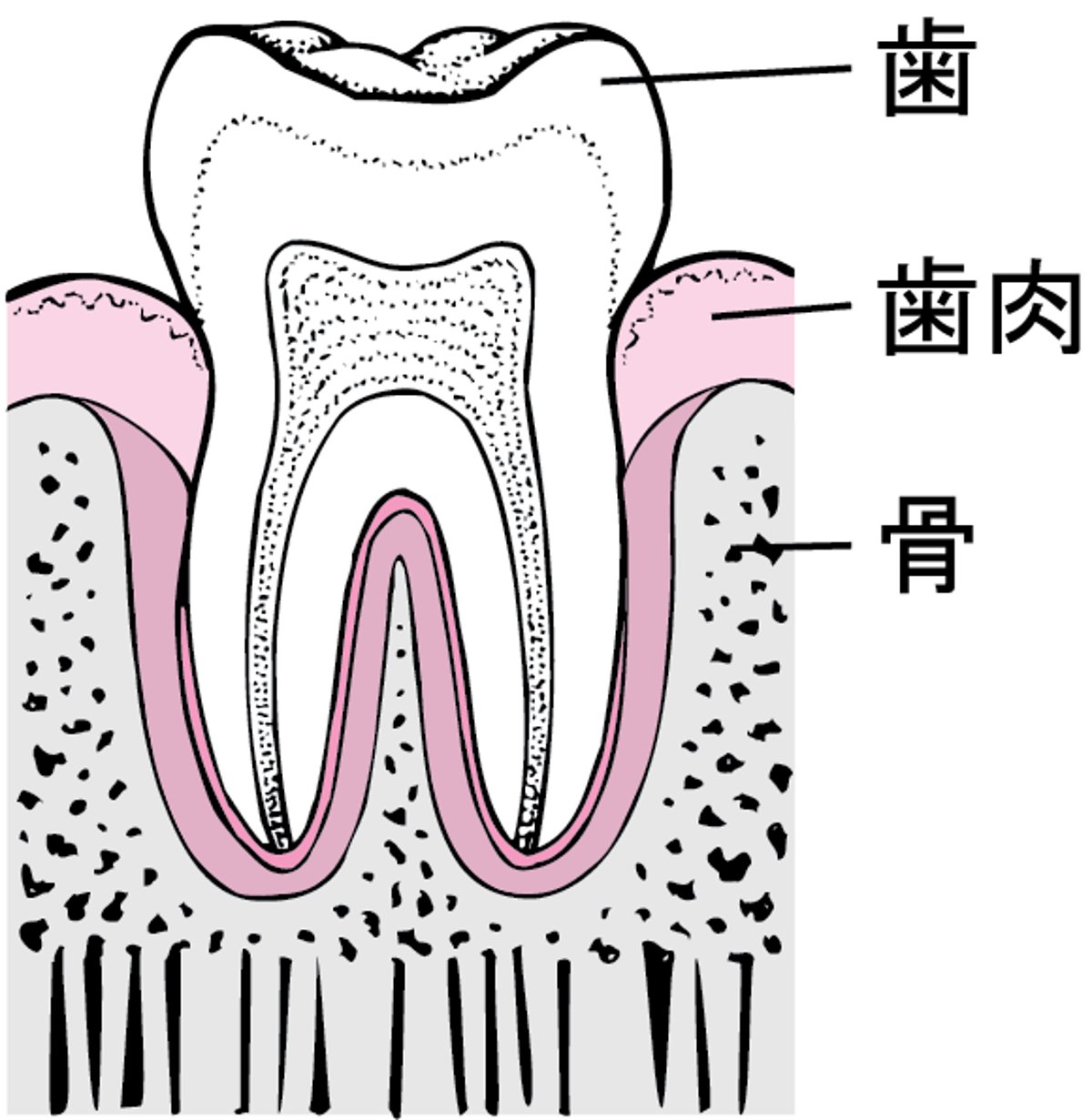 歯周炎：歯垢の蓄積から歯の喪失へ