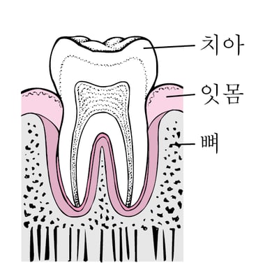 치주염: 플라크에서 치아 손실까지