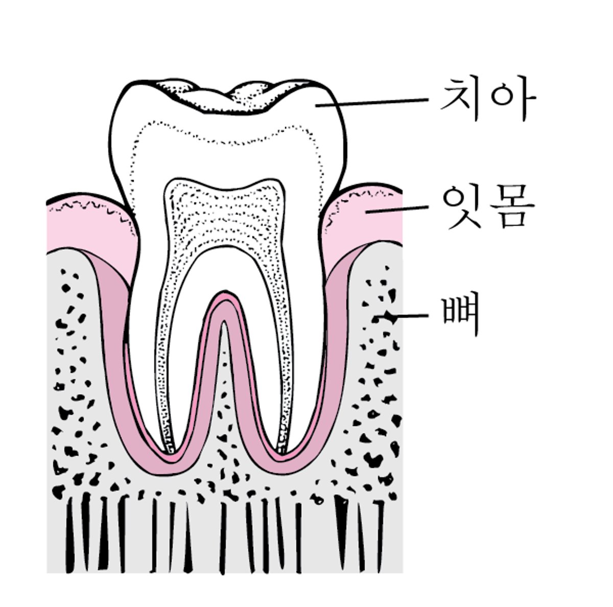 치주염: 플라크에서 치아 손실까지