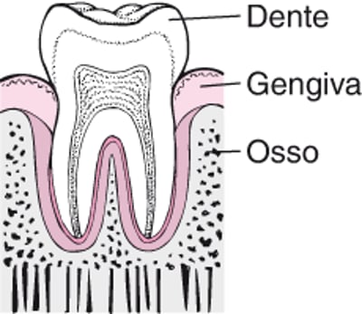Periodontite: Da placa à perda do dente