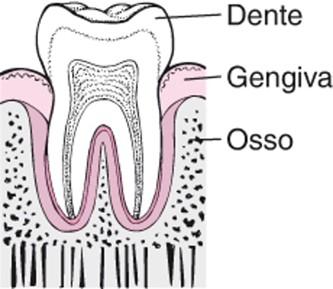 Periodontite: Da placa à perda do dente