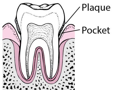 Periodontitis: From Plaque to Tooth Loss