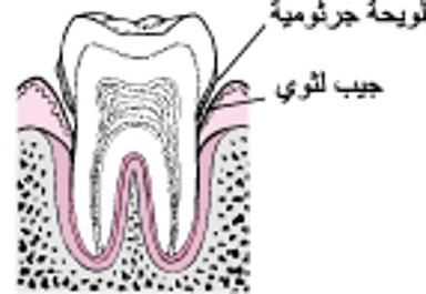 مراحل التهاب النسج الداعمة للأسنان: ابتداءً من تراكم اللويحة البكتيرية وانتهاءً بفقدان الأسنان
