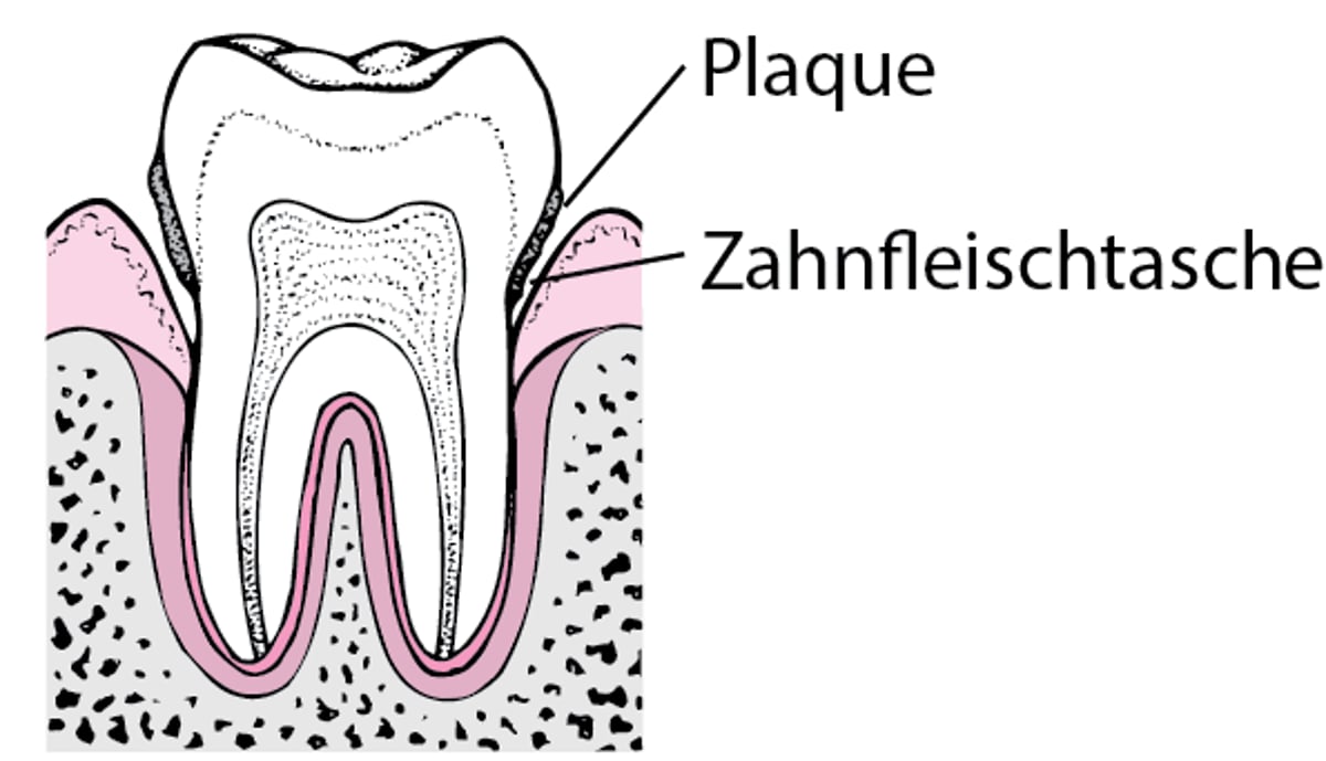 Parodontitis: Von Zahnbelägen zum Zahnverlust