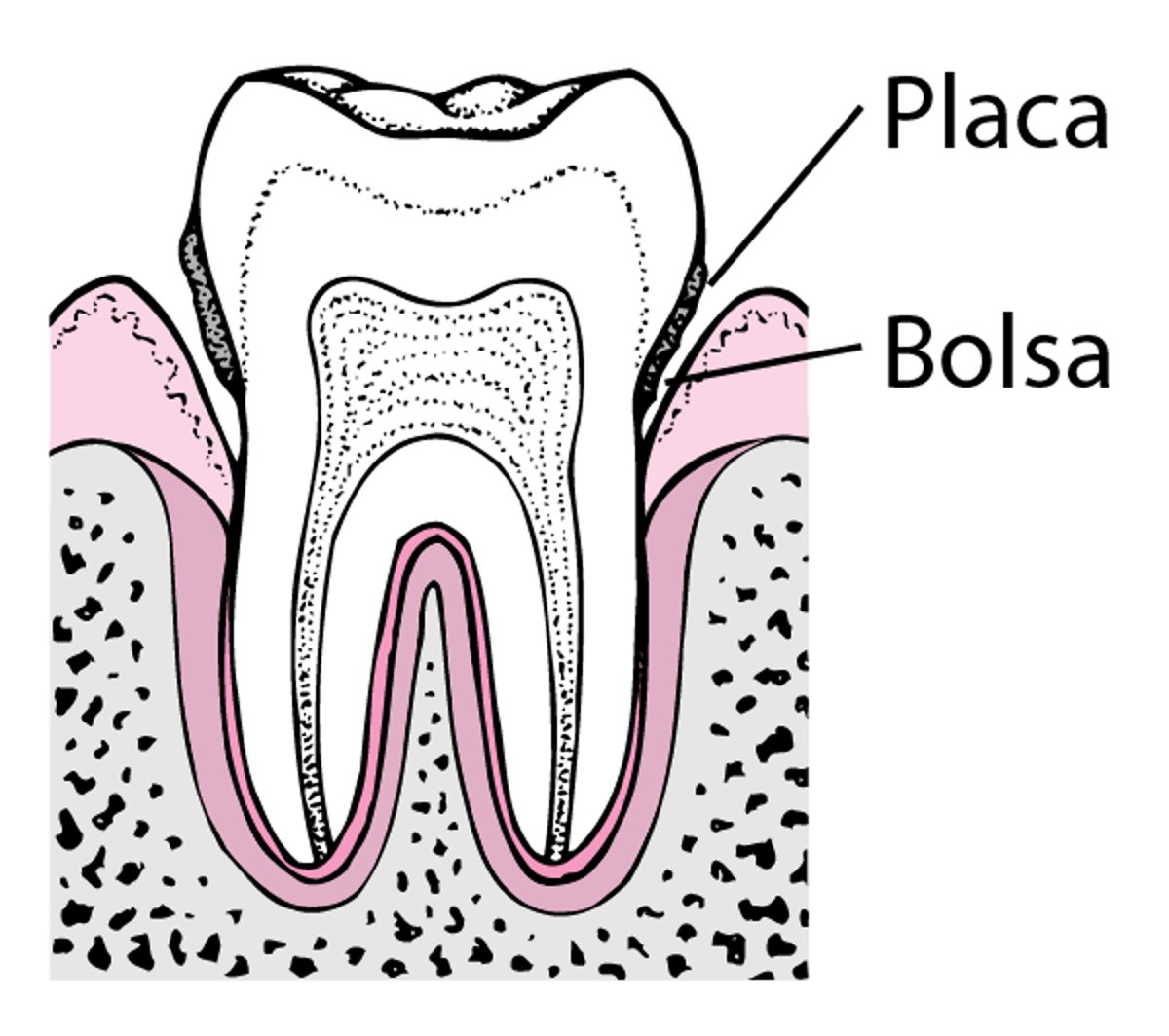 Periodontitis: de la formación de placa a la pérdida del diente
