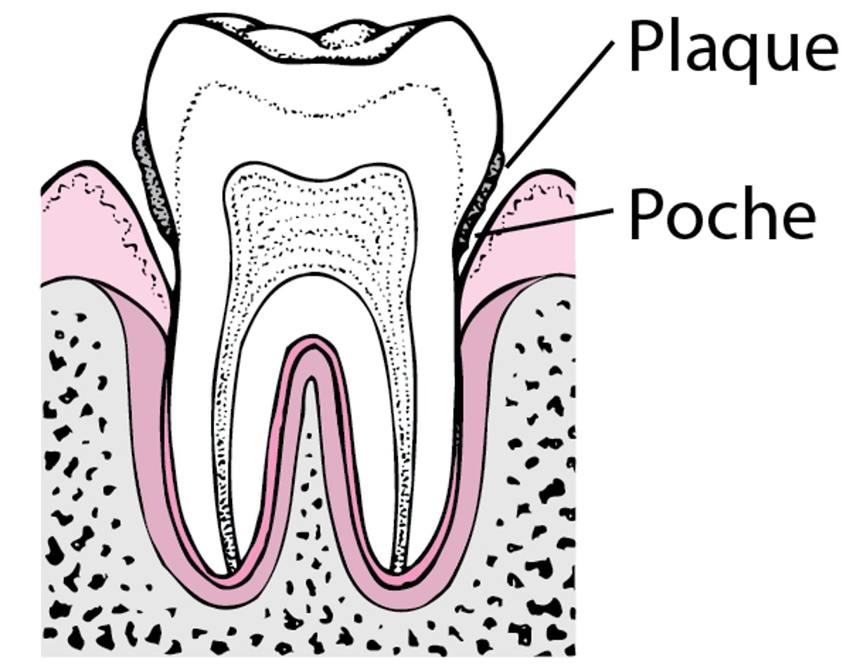Parodontite : De la plaque à la perte dentaire